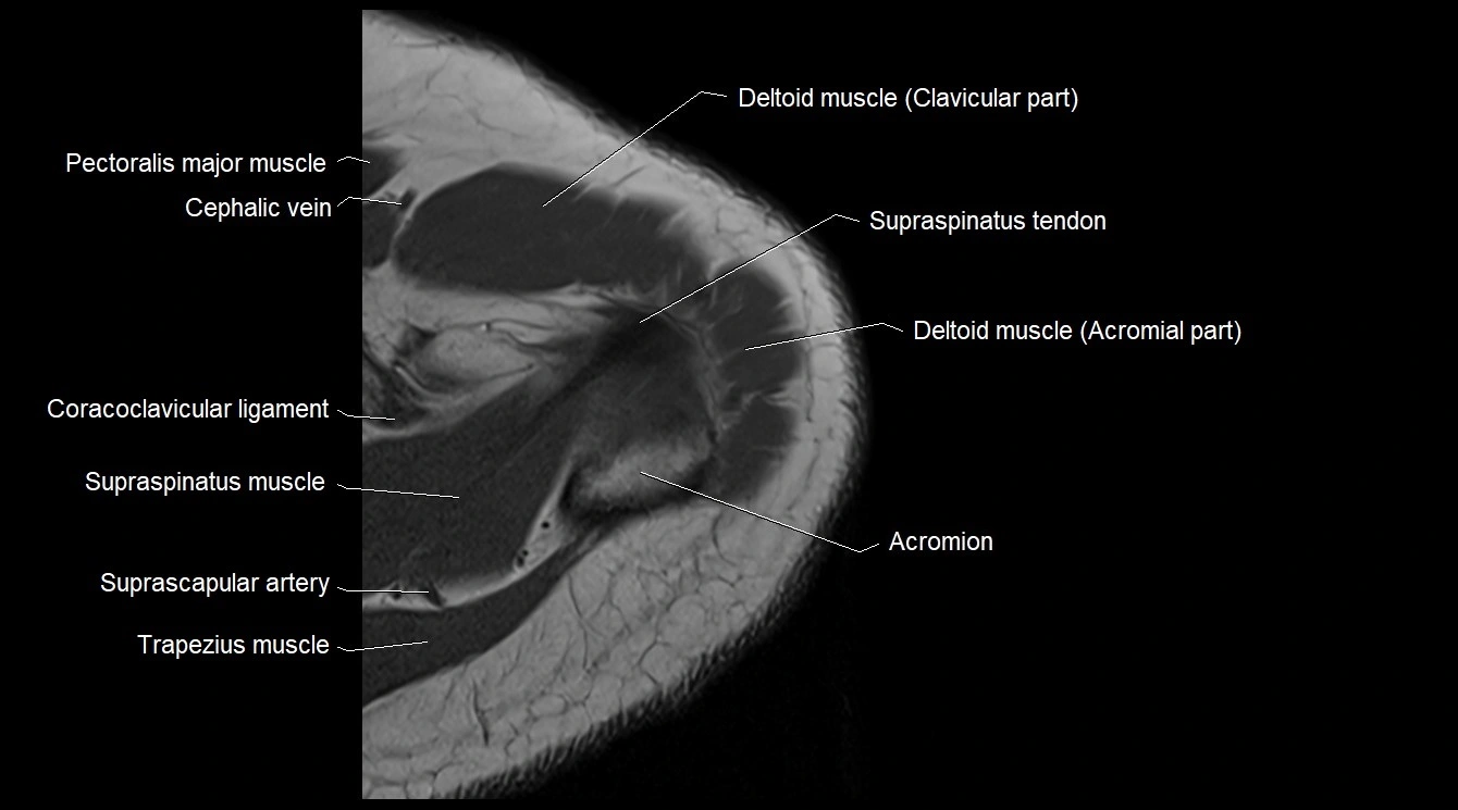 Upper arm( humerus) cross section anatomy MRI 3T axial image 6.webp
